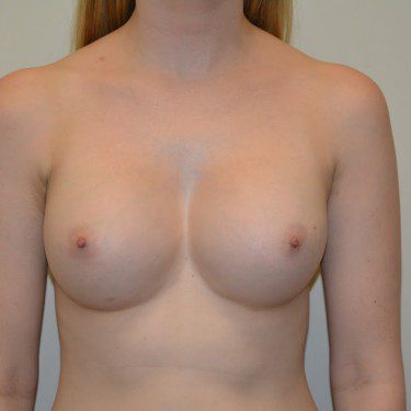 Breast Augmentation After Patient 1