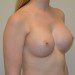 Breast Augmentation After Patient Thumbnail 2