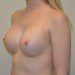 Breast Augmentation After Patient Thumbnail 3
