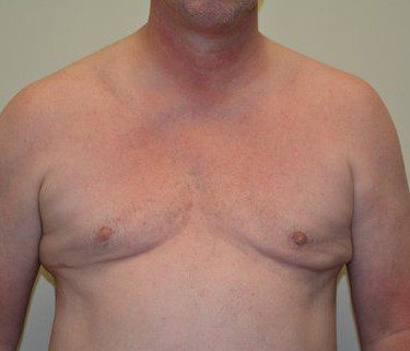 Male Breast Reduction After Patient 1