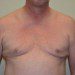 Male Breast Reduction After Patient Thumbnail 1