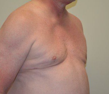Male Breast Reduction After Patient 3