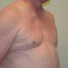 Male Breast Reduction After Patient Thumbnail 3