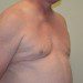Male Breast Reduction After Patient Thumbnail 3