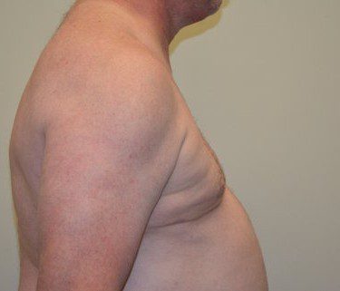 Male Breast Reduction After Patient 5