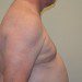 Male Breast Reduction After Patient Thumbnail 5