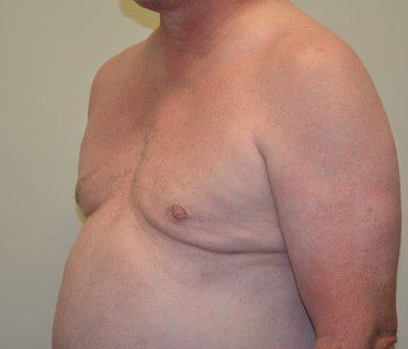 Male Breast Reduction After Patient 2