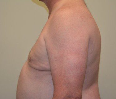 Male Breast Reduction After Patient 4