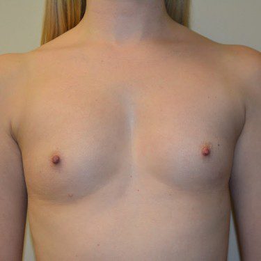 Breast Augmentation Before Patient 1