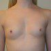 Breast Augmentation Before Patient Thumbnail 1