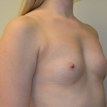 Breast Augmentation Before Patient 2