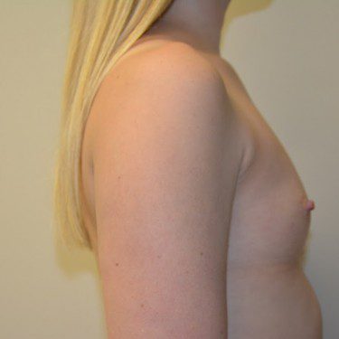 Breast Augmentation Before Patient 4