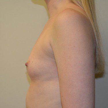 Breast Augmentation Before Patient 5