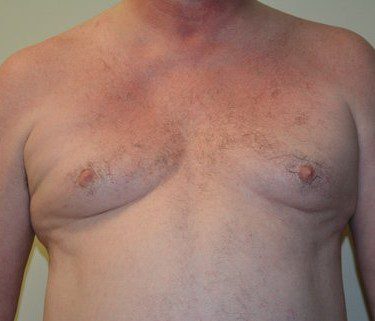 Male Breast Reduction Before Patient 1