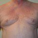 Male Breast Reduction Before Patient Thumbnail 1