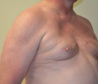 Male Breast Reduction Before Patient 3