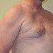 Male Breast Reduction Before Patient Thumbnail 3