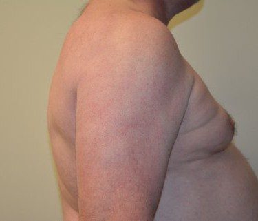 Male Breast Reduction Before Patient 5