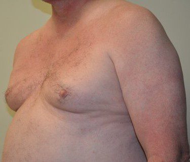 Male Breast Reduction Before Patient 2