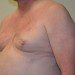 Male Breast Reduction Before Patient Thumbnail 2