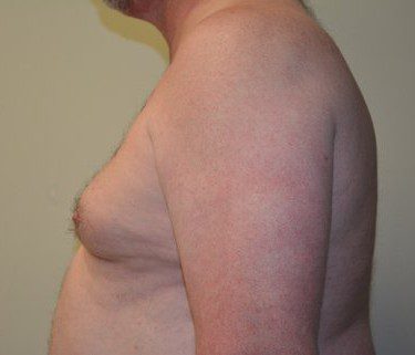 Male Breast Reduction Before Patient 4