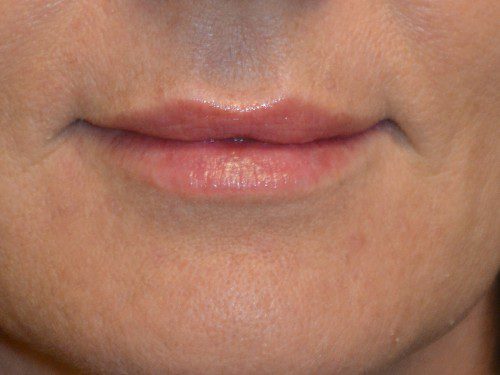 Injectable Fillers After Patient 1