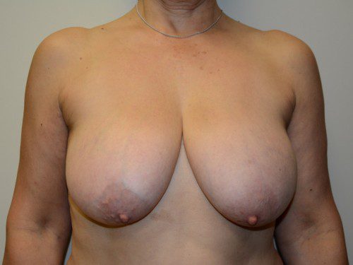 Breast Reduction Before Patient 1