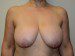 Breast Reduction Before Patient Thumbnail 1