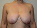 Breast Reduction Before Patient Thumbnail 1