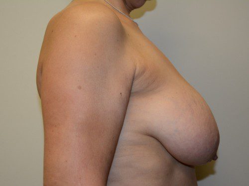 Breast Reduction Before Patient 3