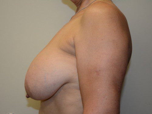 Breast Reduction Before Patient 5