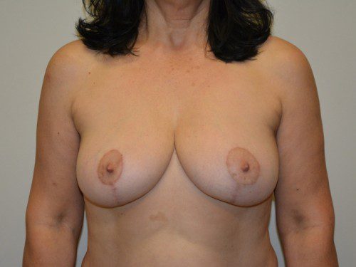 Breast Reduction After Patient 1