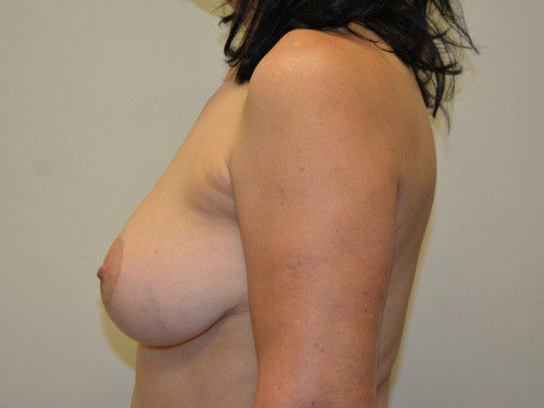 Breast Reduction After Patient 5