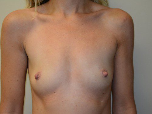 Breast Augmentation Before Patient 1