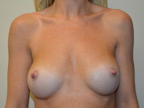 Breast Augmentation After Patient 1