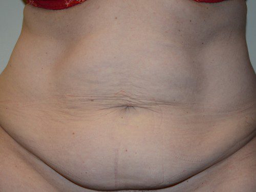 Tummy Tuck Before Patient 1