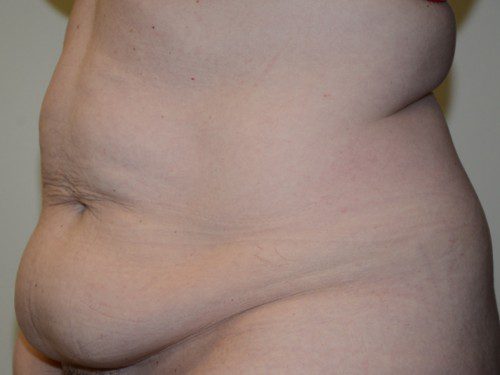 Tummy Tuck Before Patient 2