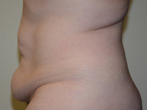 Tummy Tuck Before Patient 3