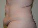 Tummy Tuck Before Patient Thumbnail 3