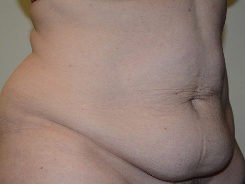 Tummy Tuck Before Patient 4