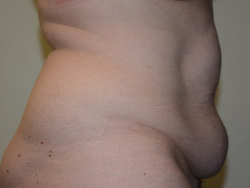 Tummy Tuck Before Patient 5