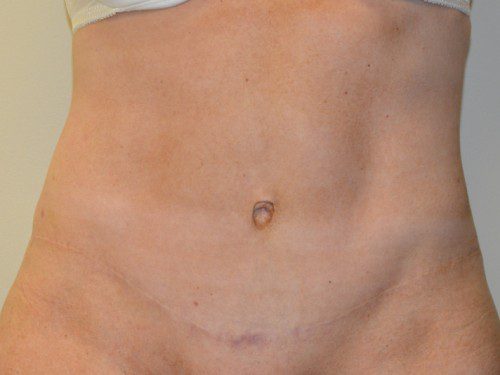 Tummy Tuck After Patient 1