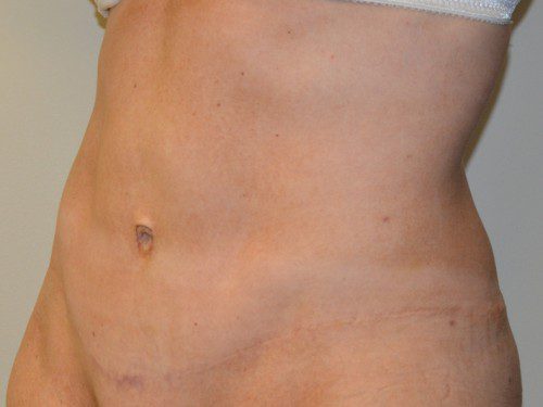 Tummy Tuck After Patient 2