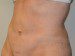 Tummy Tuck After Patient Thumbnail 2