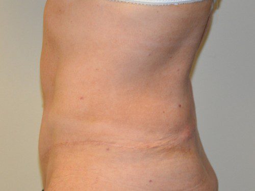 Tummy Tuck After Patient 3