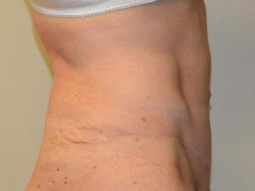 Tummy Tuck After Patient 5