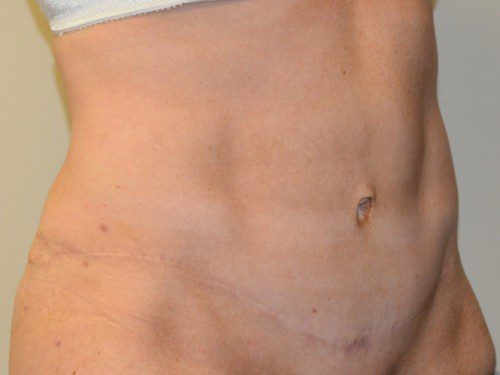 Tummy Tuck After Patient 4