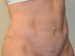 Tummy Tuck After Patient Thumbnail 4