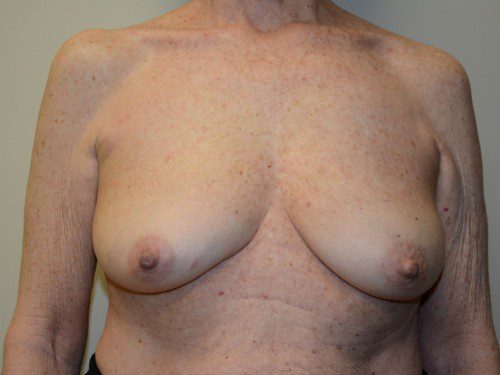 Breast Reconstruction Tissue Expanders Before Patient 1