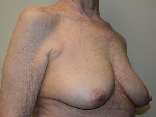 Breast Reconstruction Tissue Expanders Before Patient 4